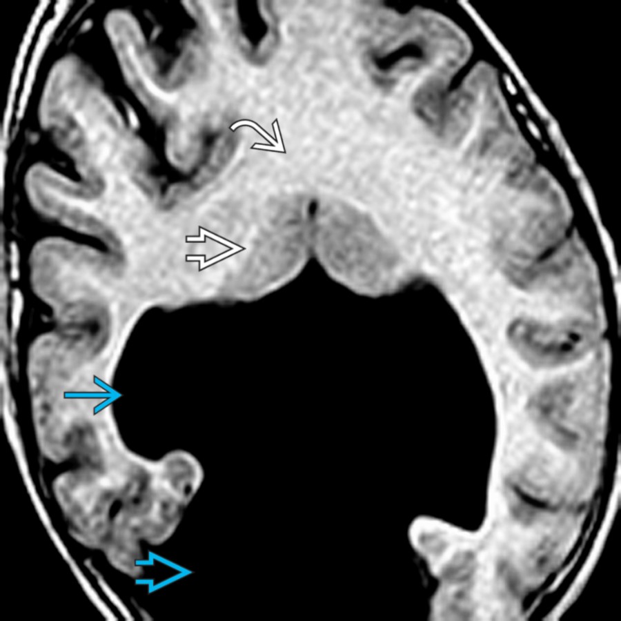 Axial T1 MR in a patient with holoprosencephaly shows the lack of a midline fissure. White matter
is in continuity across the midline. The small basal ganglia
approximate each other. Note the monoventricle
communicating with a dorsal cyst
.