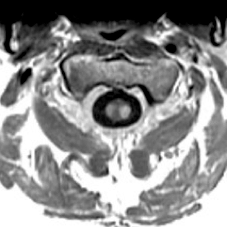 Axial T1 C+ MR shows focal enhancement within the right & left lateral aspect of the cervical cord in this patient with active MS plaques.