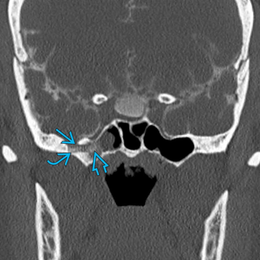 Coronal CT cisternogram in a patient with IIH shows an osteodural defect
along the great wing of the sphenoid. Defect along the lateral wall of the sphenoid sinus
with a meningocele and contrast
in the lateral sphenoid sinus due to CSF leak is shown. Patients with IIH can present with spontaneous CSF leaks.