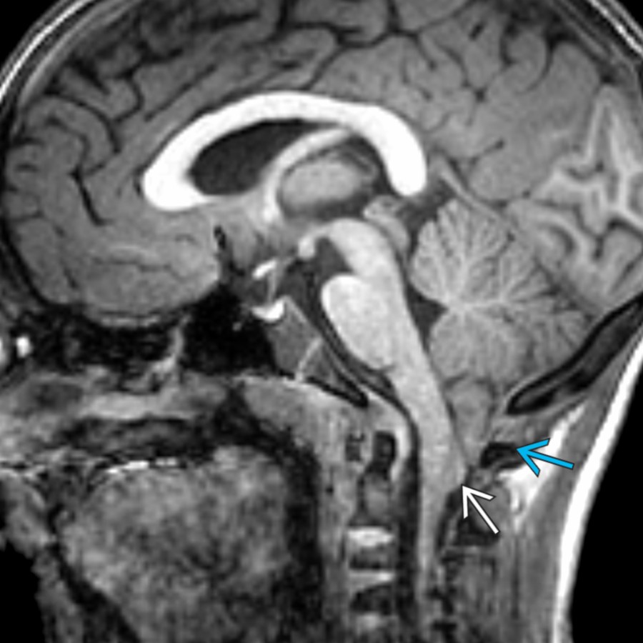 Sagittal T1 MR of an 8-year-old with boy incidentally noted Chiari 1 malformation (CM1) demonstrates pointed, low-lying cerebellar tonsils reaching the level of the posterior C1 arch
as well as downward displacement of the brainstem with cervicomedullary junction just below C1 posterior arch
.
