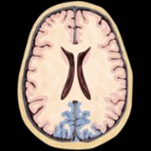 Transaxial graphic of the brain outlines the occipital lobe in blue.