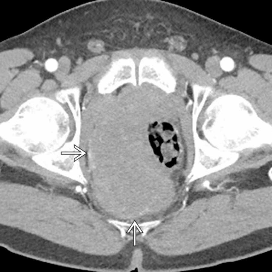 Axial CECT demonstrates a large, homogeneous mass
in the deep pelvis involving the rectosigmoid colon and portions of the small bowel. While this was prospectively thought to perhaps be a gastrointestinal stromal tumor on imaging, it turned out to be a desmoid tumor at resection.