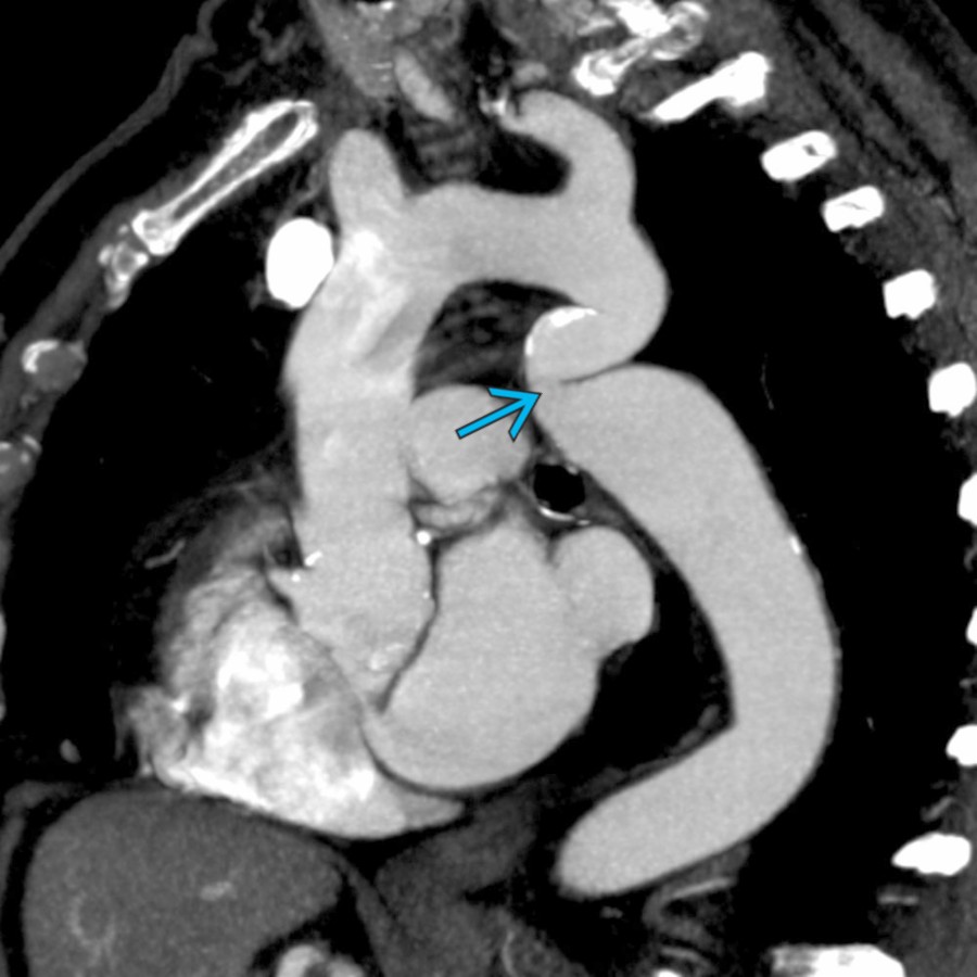 PCOA in an asymptomatic 72-year-old woman shows elongation and kinking
of the proximal DTA. There was no gradient across the lesion on phase-contrast MR. The aorta is aneurysmal distal to PCOA, measuring 3.5 cm.