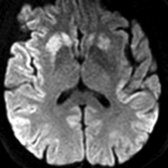 Axial DWI MR shows asymmetric diffusion restriction in the caudate nuclei and putamen. Involvement of the anterior more than the posterior putamen is typical of CJD. There is also asymmetric hyperintensity in the frontal and temporal lobe cortical ribbons
, typical of sCJD. (Courtesy N. Fischbein, MD.)