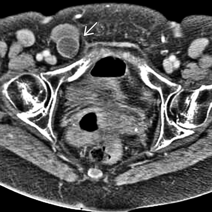 Axial CECT shows a "knuckle" of fluid-filled small intestine strangulated within the right inguinal hernia
.
