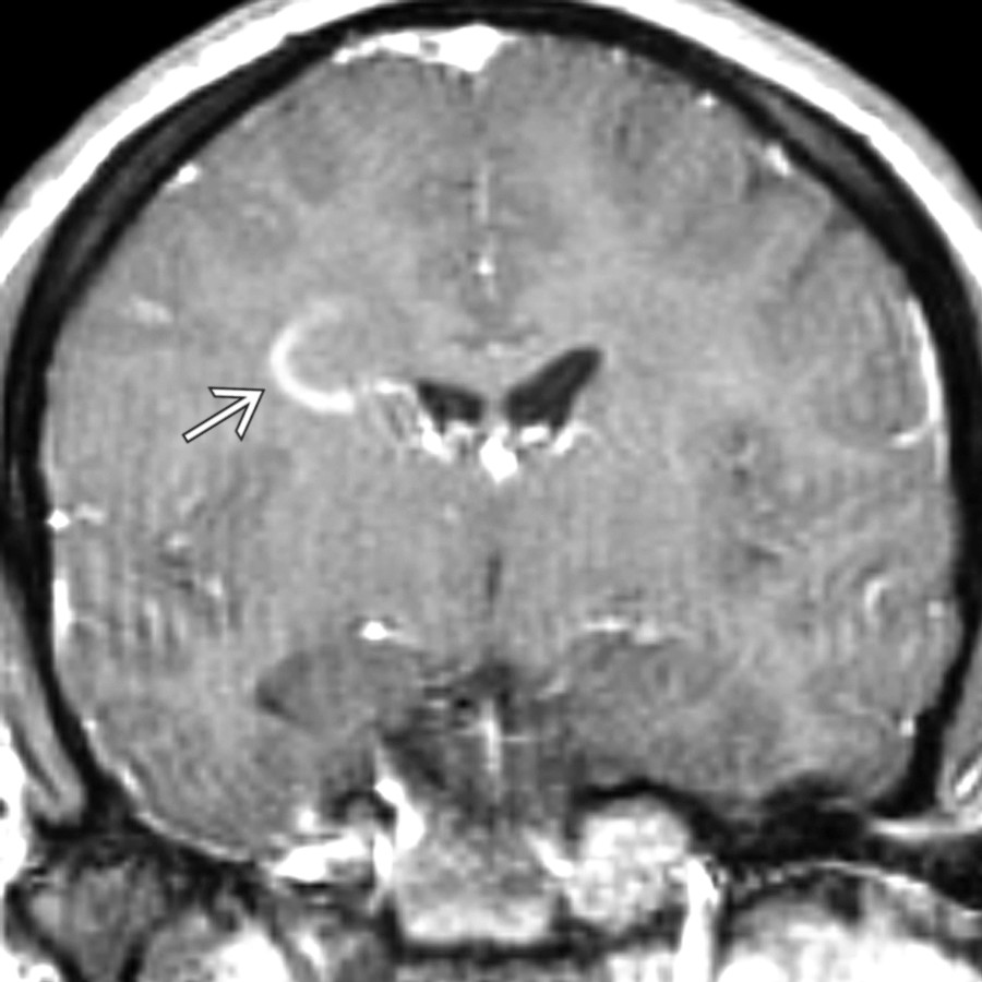 Coronal T1 C+ MR shows classic incomplete ring-enhancing focus in the right frontal WM
with minimal mass effect. No other enhancing foci were seen.