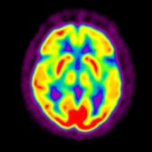 More inferior axial F-18 FDG PET in the patient with MCI shows hypometabolism of the temporal
and frontal
cortices. Importantly, there is sparing of the basal ganglia
and visual cortex
.