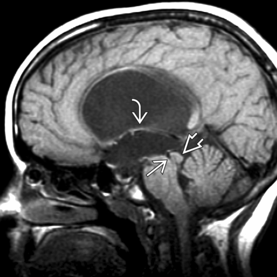 Sagittal T1WI MR depicts proximal aqueductal stenosis
producing enlargement of the lateral and 3rd ventricles with depression of the fornices
in conjunction with normal 4th ventricle size. The tectum is dysplastic and thickened with collicular fusion
.
