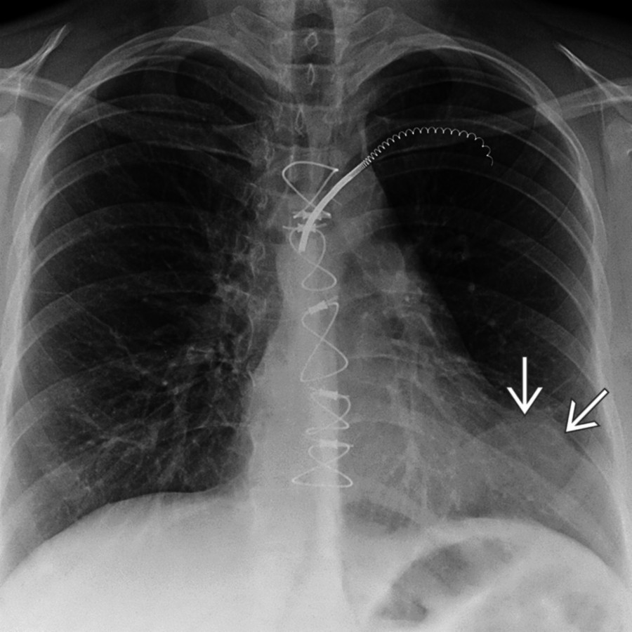 Frontal radiograph shows left cardiac border contour deformity
. CT showed abdominal fat, which had herniated into the left cardiophrenic space.