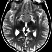 Axial T2 MR shows a mass in the suprasellar
and pineal
region in a teenage male patient with visual symptoms. The low signal is related to a high nuclear:cytoplasmic ratio.