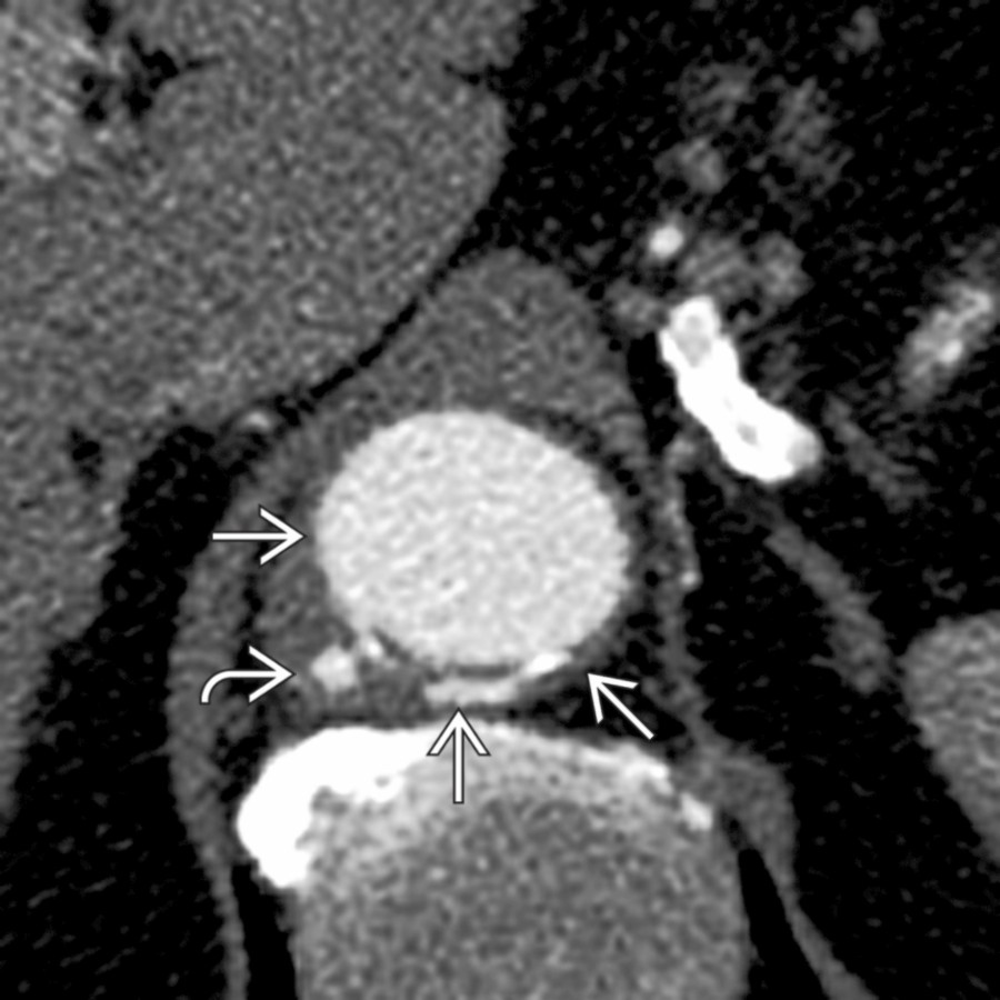 Axial CECT shows a small focus of contrast
extending beyond the expected aortic wall
. Adjacent wall thickening suggested it is likely acute and explains the patient's back pain.