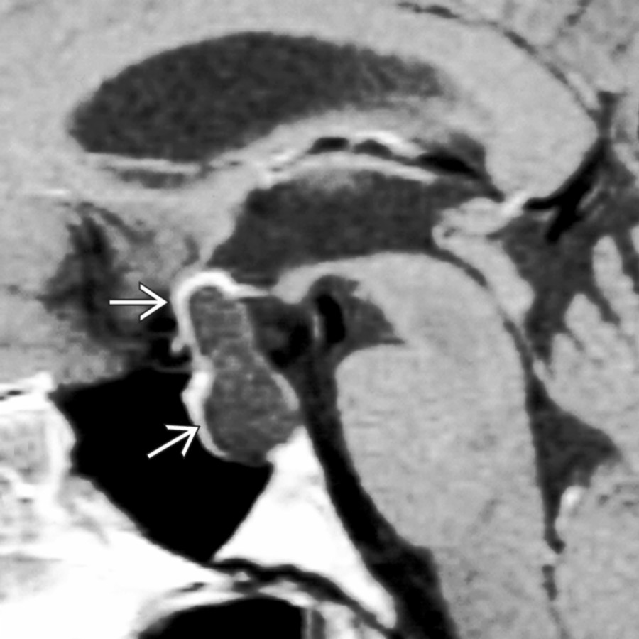 Sagittal T1 C+ MR shows an intra- and suprasellar cyst that does not enhance. Note the displaced pituitary gland and infundibular stalk
form a "claw" around the lesion.