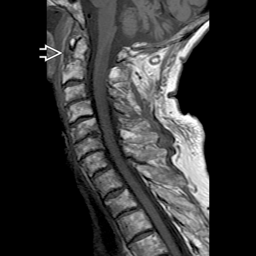 Sagittal T1WI MR shows a well-defined fracture line
. MR is useful for defining soft tissue abnormalities but should not be relied upon for pure bony fracture identification.