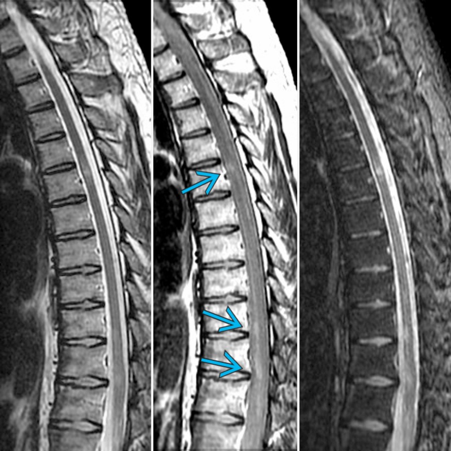 Sagittal T2 (left), PD (middle), & STIR (right) MR show multiple short-segment multiple sclerosis (MS) plaques within the thoracic cord
. Note the relatively improved conspicuity of the plaques on the PD & STIR relative to the routine T2 sequence.