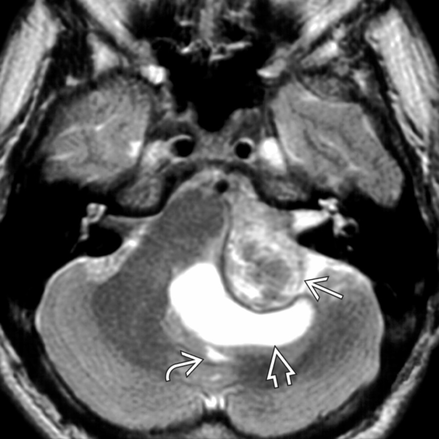 Axial T2WI MR shows a vestibular schwannoma
projecting from the IAC into the CPA cistern. An associated (extramural) arachnoid cyst is visible
compressing the brainstem and 4th ventricle
.