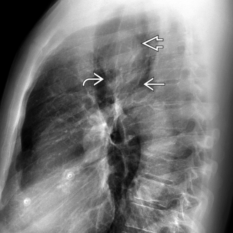 Lateral chest radiograph in the same patient demonstrates forward buckling of the aortic arch
at the isthmus. The aorta
is enlarged proximal to the narrowed segment
.