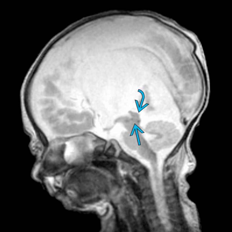 Sagittal T2WI MR of a 5 day old with prenatal diagnosis of aqueductal stenosis demonstrates effacement of the cerebral aqueduct
with thickening of the tectum
.