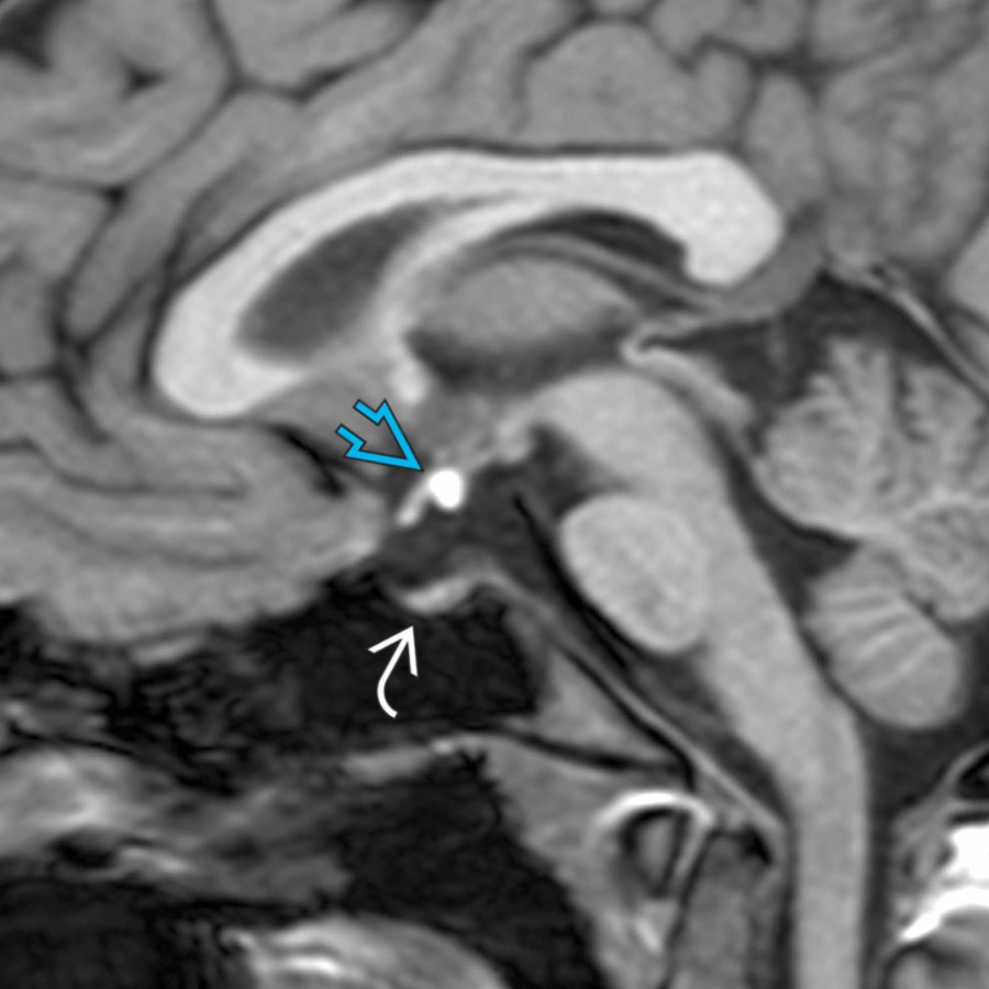 Sagittal T1 MR shows an ectopic posterior pituitary gland in a 17-year-old girl with short stature. The T1-hyperintense posterior gland is at the median eminence
instead of its normal position. The pituitary infundibulum is absent and the anterior pituitary gland
is small.