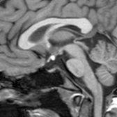 Sagittal T1 MR shows an ectopic posterior pituitary gland in a 17-year-old girl with short stature. The T1-hyperintense posterior gland is at the median eminence
instead of its normal position. The pituitary infundibulum is absent and the anterior pituitary gland
is small.