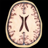 Axial graphic illustrates the presence of amyloid plaques in the cerebral gray matter
.