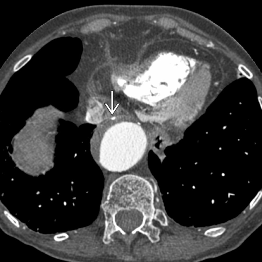 Axial CECT shows a mural thrombus in an otherwise dilated aorta. Note that intimal calcifications are on the outer edge of the thrombus
.