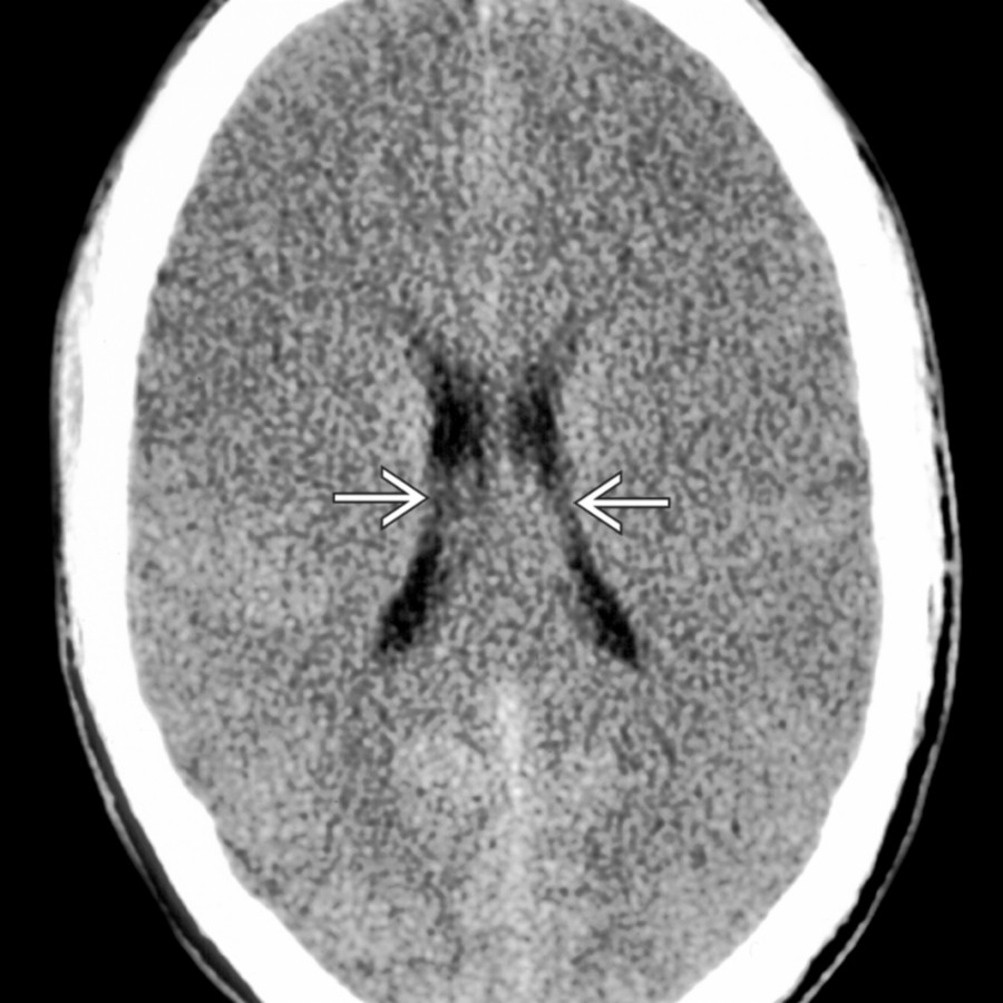 Axial NECT shows a typical case of impending brain death with diffuse cerebral edema. Note diffuse sulcal effacement, small ventricles
, and decreased gray-white matter differentiation within the cerebral hemispheres.