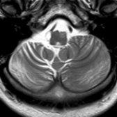 Axial T2 MR in the same patient shows ipsilateral hypertrophic olivary degeneration
(chronic, with shrunken hyperintense olive). CCD with atrophy of the contralateral cerebellar hemisphere is also present
. While CCD is usually caused by an MCA stroke in the contralateral cerebral hemisphere, interruption of the corticopontocerebellar (CPC) tract anywhere along its course can result in similar findings. In this case, midbrain surgery caused deafferentation of the contralateral cerebellar hemisphere. It is rare to find both hypertrophic olivary degeneration & CCD in the same patient.