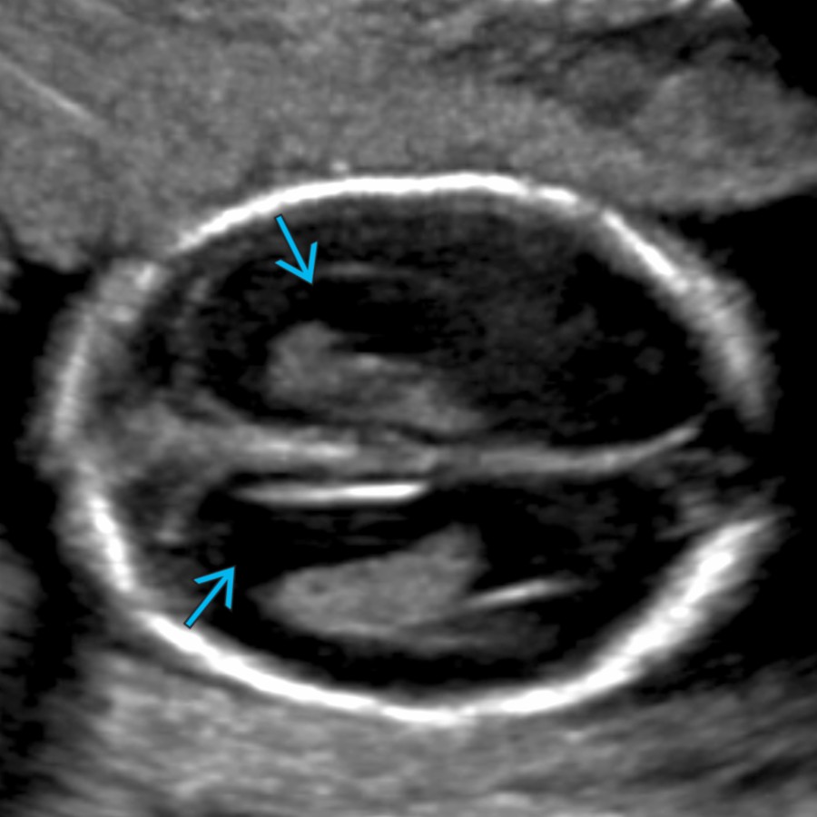 Transverse oblique US in an 18-week fetus shows mild enlargement of the lateral ventricles
(11 mm). If the ventriculomegaly worsens later in pregnancy, fetal or postnatal MR imaging should be obtained.