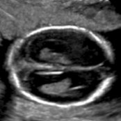 Transverse oblique US in an 18-week fetus shows mild enlargement of the lateral ventricles
(11 mm). If the ventriculomegaly worsens later in pregnancy, fetal or postnatal MR imaging should be obtained.