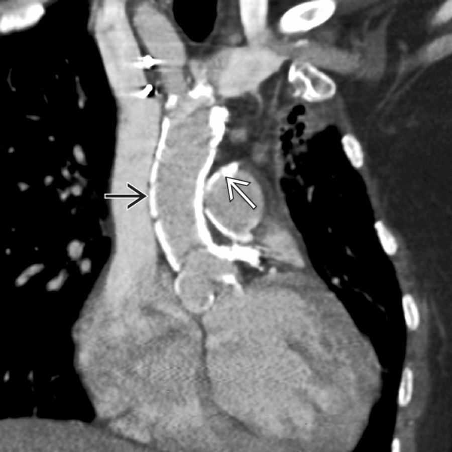 Double oblique CECT shows dense aortic
and pulmonary artery
calcifications in a patient who received prior mediastinal radiation. Vascular calcifications were not present elsewhere. Note that calcifications are spatially confined to the radiation field.