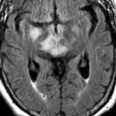 Axial FLAIR MR shows abnormal hyperintensity in the right medial temporal lobe and midbrain in this patient with a history of limbic encephalitis and new brainstem symptoms positive for anti-Hu autoantibody.