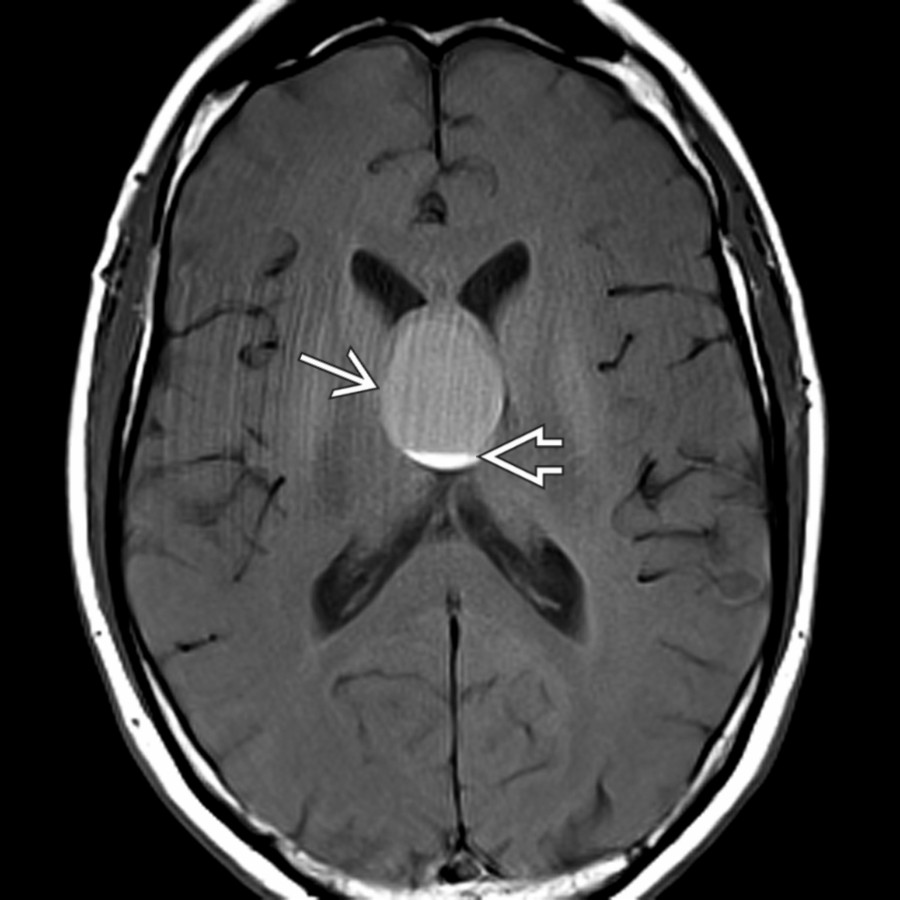 Axial T1WI MR in a 52-year-old man with headache, amnesia, and TIA-like symptoms shows a large, mildly hyperintense, well-delineated mass
in the 3rd ventricle and foramen of Monro. Note the blood-fluid level
in the dependent part of the mass.