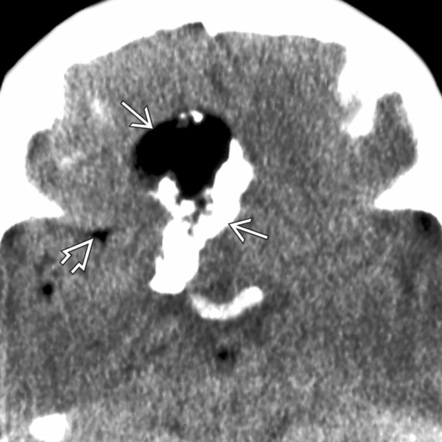 Axial NECT shows a large, mixed density suprasellar and subfrontal mass
. Low density "droplets" that resemble fat are seen in the adjacent sylvian fissure
in this patient with a ruptured dermoid. Ca⁺⁺ may be seen in up to 20% of dermoid cysts.