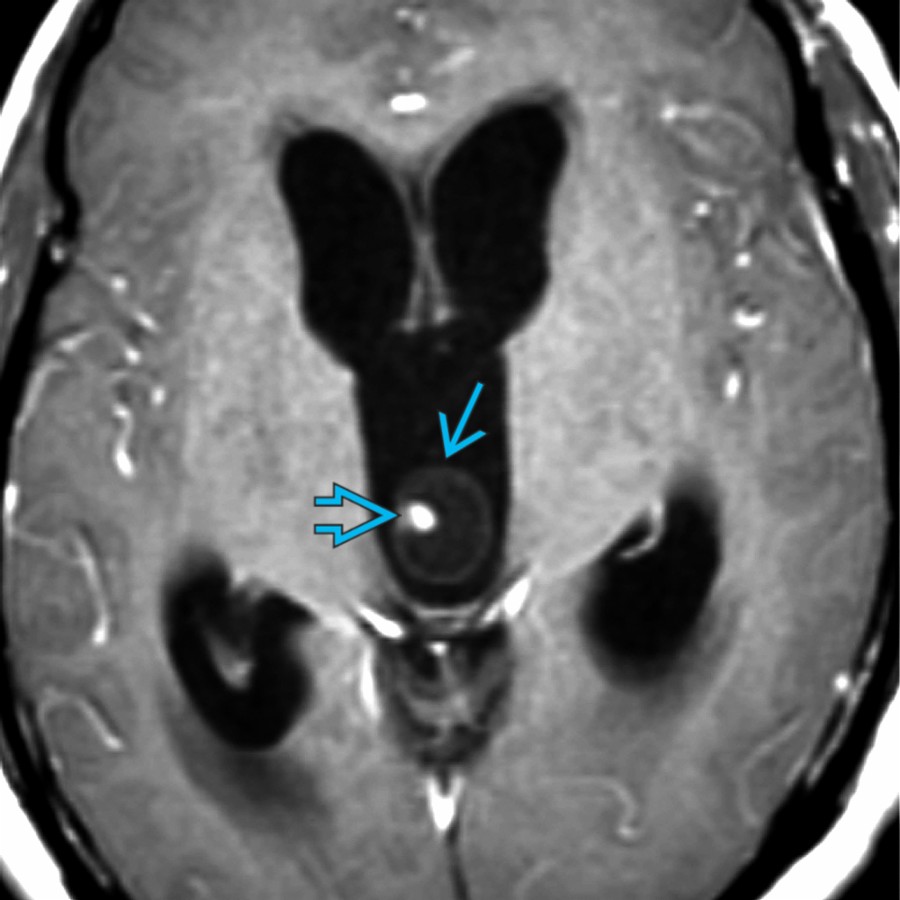 Axial T1WI C+ MR shows large lateral 3rd ventricles with "blurred" margins from transependymal CSF flow. A cysticercus cyst
with scolex
causes obstructive hydrocephalus. Intrinsic 3rd ventricle masses are less common than lateral or 4th ventricular lesions.