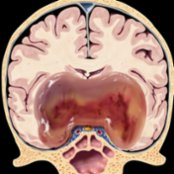 Coronal graphic depicts a pilomyxoid astrocytoma (PMA). Note the large, bulky, H-shaped mass
centered in the hypothalamic/chiasmatic region and extending into both temporal lobes. The tumor is relatively well circumscribed and shows little/no edema. Glistening myxoid matrix is typical. Hemorrhage
occurs in ~ 20% of PMAs but is unusual in pilocytic astrocytoma (PA).