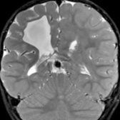 Coronal T2 FS MR in a 2-month-old born to a mother using methamphetamine shows a well-circumscribed right frontal porencephalic cyst without surrounding edema or mass effect. The cyst was likely due to intrauterine vascular injury to the periventricular white matter.