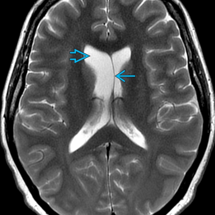 Axial T2 MR demonstrates normal variant anatomy with mild asymmetric prominence of the right lateral ventricle
when compared to the left. Note the septum is slightly deviated to the left
.