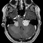 Axial T1 C+ MR shows bilateral enhancing tumors in the internal auditory canals compressing the brainstem
, consistent with bilateral vestibular schwannomas, pathognomonic for neurofibromatosis type 2. Search for additional cranial nerve schwannomas and dural margin meningiomas.