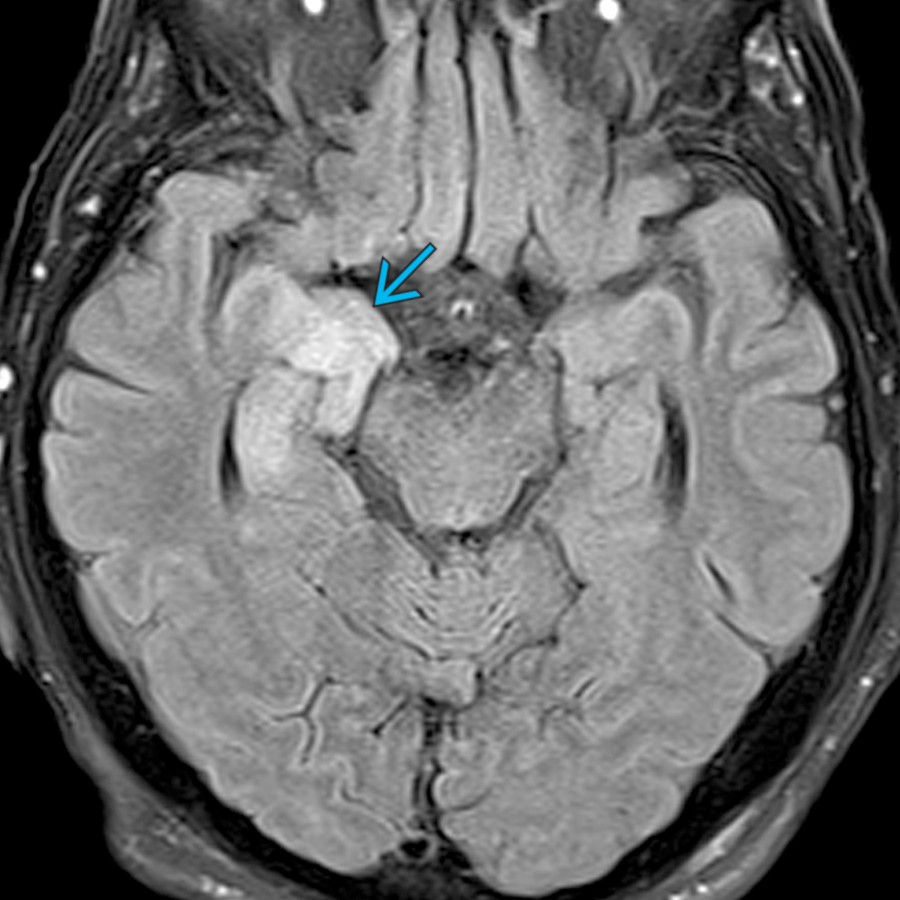 Axial FLAIR MR shows hyperintensity in the medial temporal lobes
in this patient with subacute dementia and voltage-gated potassium channel (VGKC) autoimmunity. VGKC may occur with or without a primary neoplasm and may have an LE pattern.