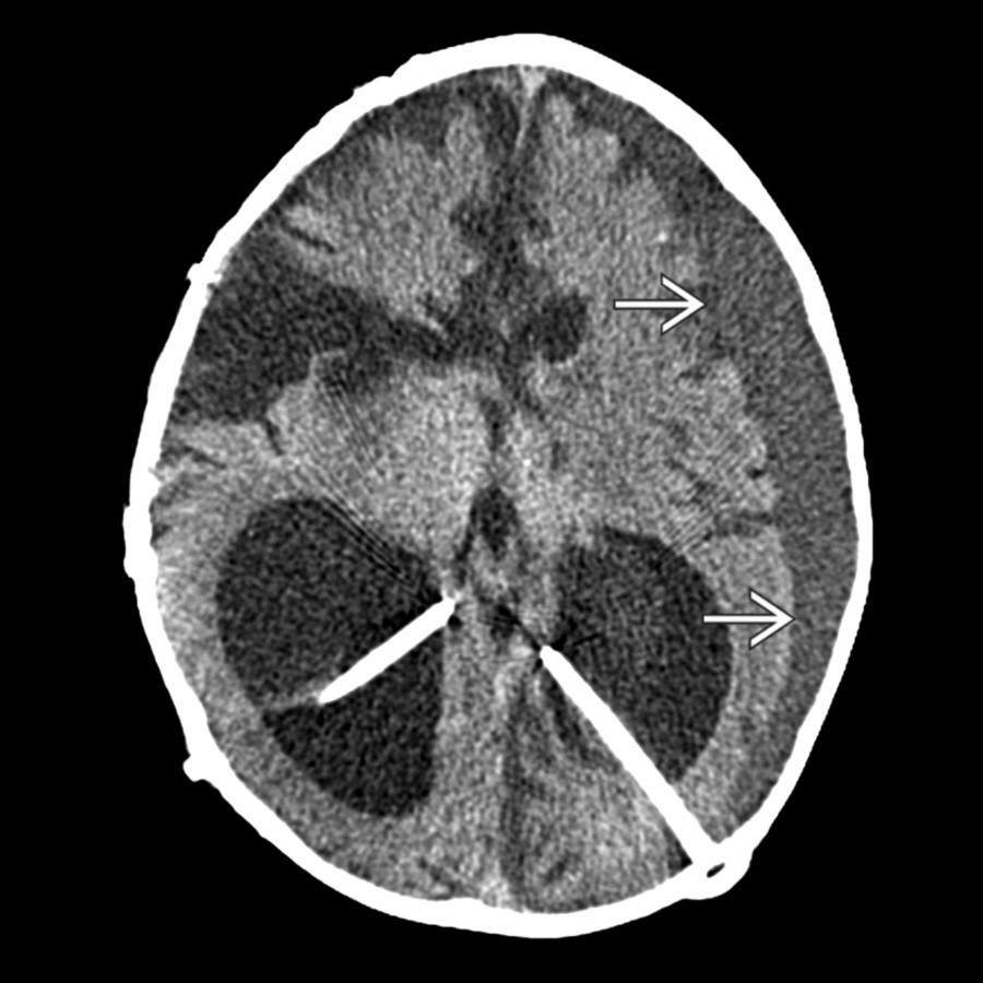 Axial NECT following bilateral ventricular catheter placement in a patient with severe hydrocephalus (HCP) and brain atrophy reveals development of a large left subdural hematoma
following VP shunting.