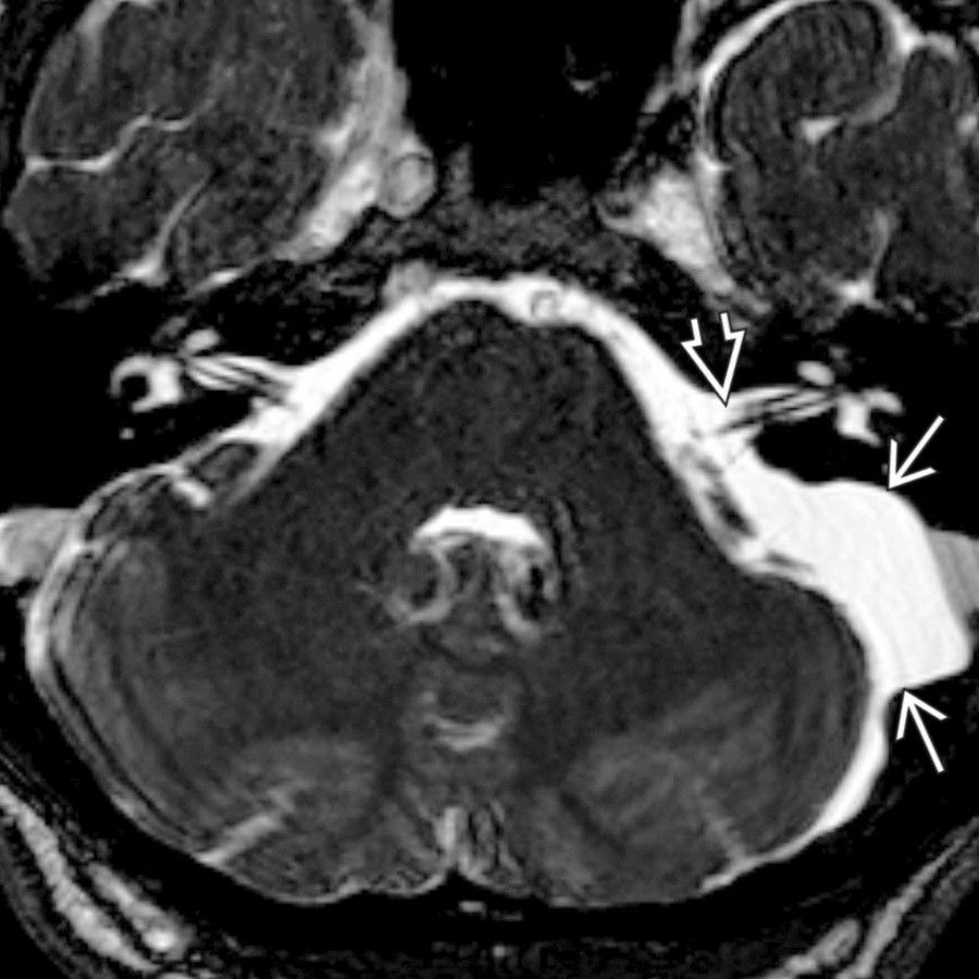 Axial FIESTA in a teenager with epilepsy shows an incidental left CPA arachnoid cyst
, isointense to intraventricular CSF, without mass effect on the cisternal segments of the 7th/8th cranial nerves
and without extension into the IAC.