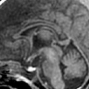 Midline sagittal T1 MR in a normal term neonate shows a thin, unmyelinated corpus callosum (CC)
. The CC will gradually thicken as it myelinates from posterior to anterior. Note that the entire pituitary gland normally shows T1 shortening
in the 1st few weeks of life.