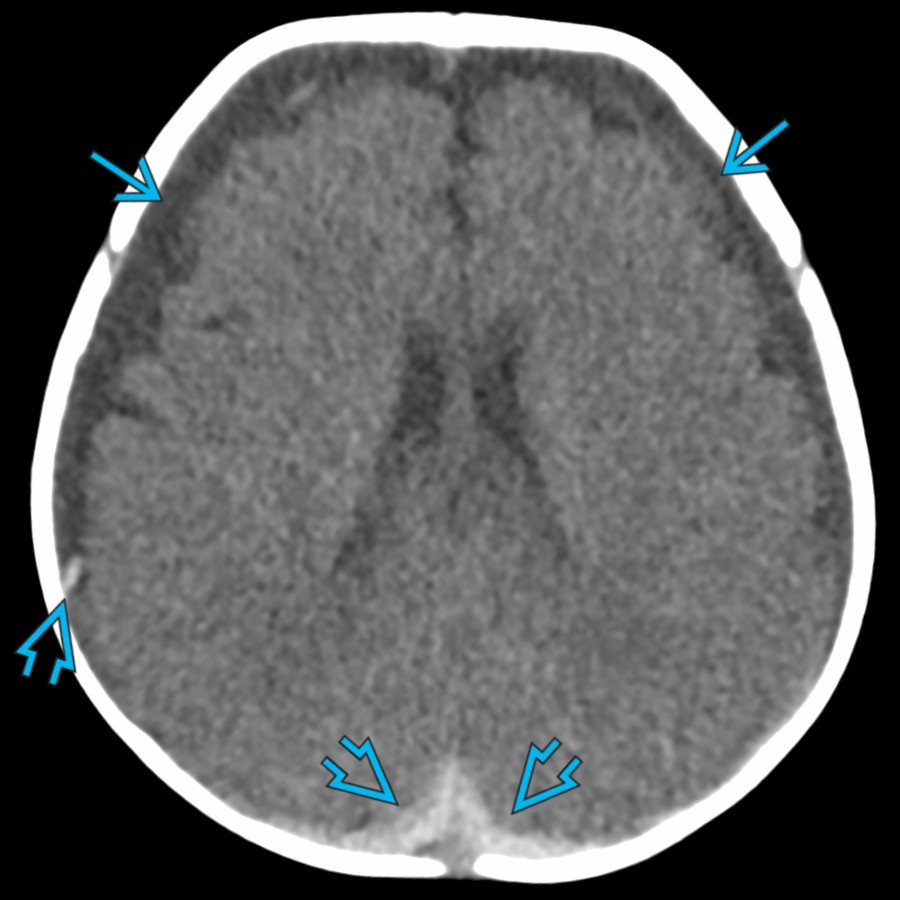 Axial NECT in a 9-week-old with seizures shows bilateral mixed attenuation subdural fluid collections with predominantly low attenuation anteriorly
& high attenuation posteriorly
, consistent with a hematohygroma. This should not be described as "acute on chronic" subdural hemorrhage.