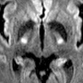 A 56-year-old man with a clinical diagnosis of amyotrophic lateral sclerosis (ALS) presents with progressive bilateral lower extremity weakness (he has been wheelchair bound for 6 months of symptom onset). Axial DWI MR shows hyperintense signal in posterior limb of bilateral internal capsules
.