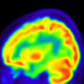Sagittal F-18 FDG PET in a patient with FTD shows predominantly frontal hypometabolism
.