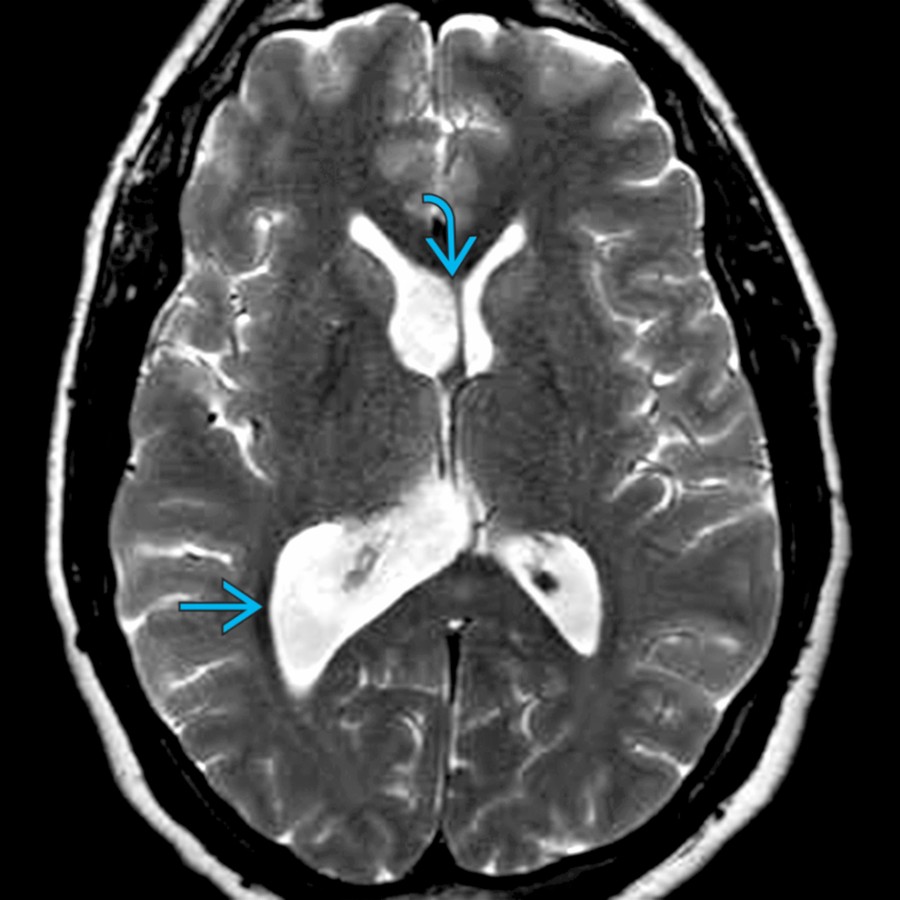 Axial T2WI MR shows lateral ventricles with the right
being larger than the left, representing a normal variant. Note mild bowing of the septum pellucidum across the midline
.