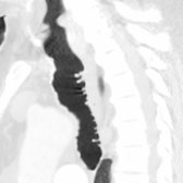 Sagittal NECT (MIP reformation) of a patient with Mounier-Kuhn syndrome shows tracheal dilatation
with abundant characteristic tracheobronchial diverticula
. Tracheobronchial dilatation leads to impaired airway secretion clearance associated with recurrent infection and cough.