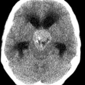 Axial NECT shows a predominantly solid, minimally calcified
, suprasellar craniopharyngioma.