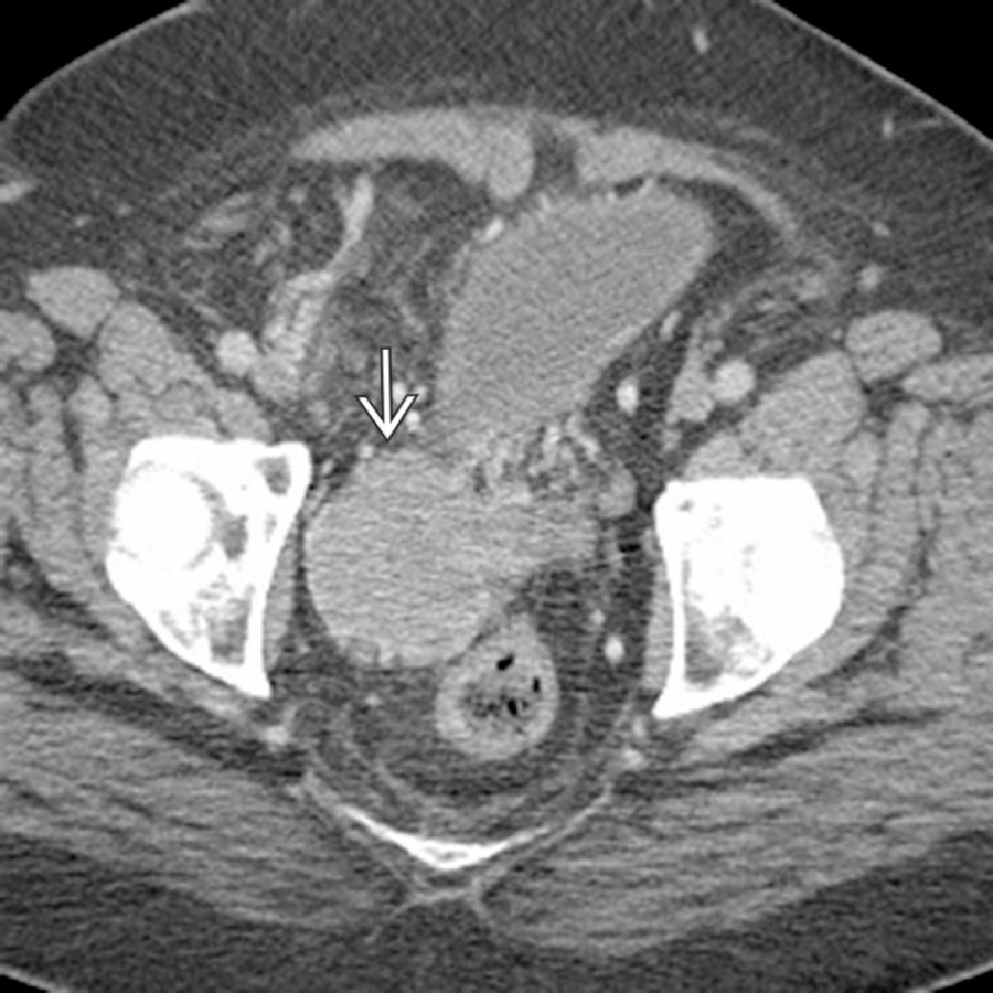 Axial CECT demonstrates a homogeneously enhancing mass
in the right hemipelvis.