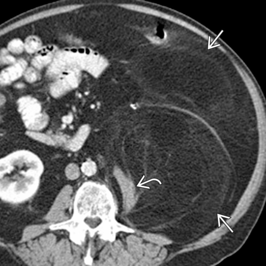 Axial CECT shows a large, fat-containing mass
occupying much of the left abdomen with the left psoas muscle
appearing stretched and distorted as a result of the retroperitoneal tumor. This was found to be a well-differentiated liposarcoma at resection.